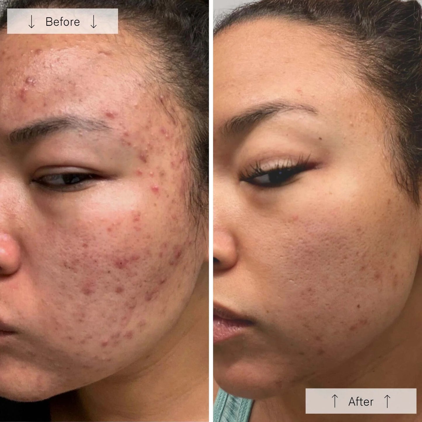 Omnilux Clear │ Blue + Red LED Device for Acne