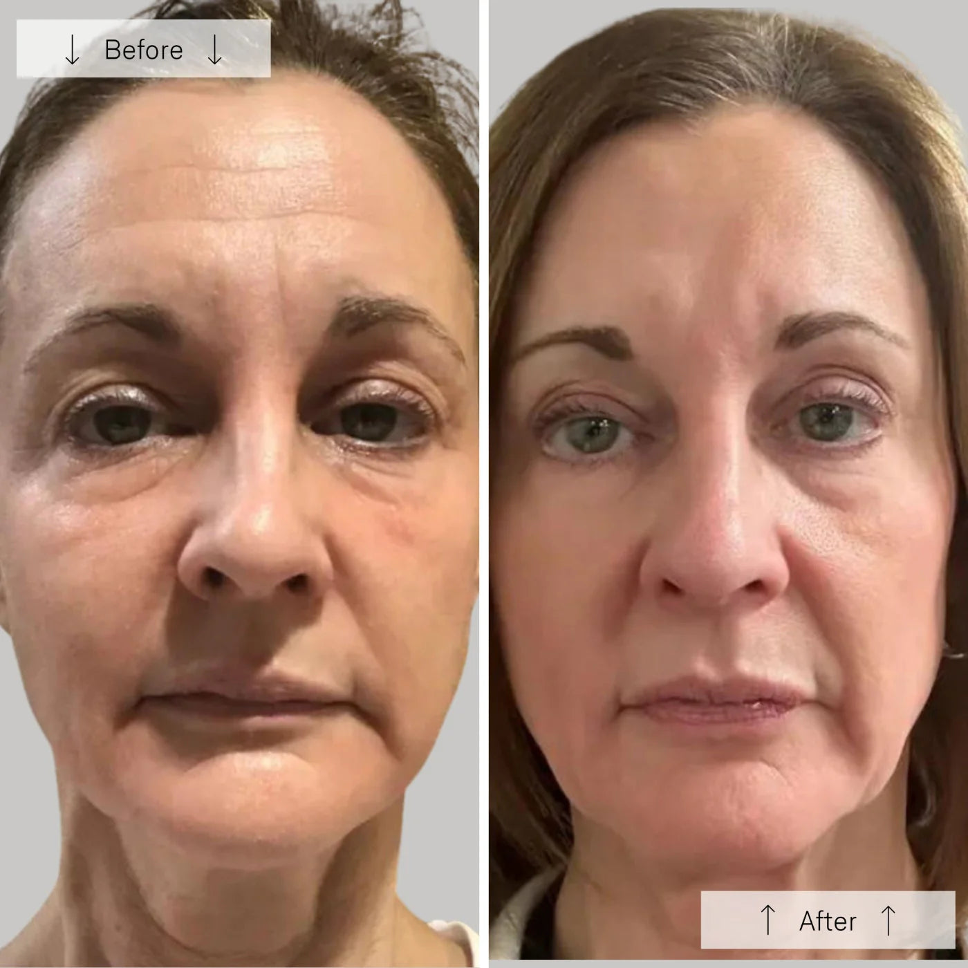 Omnilux Contour Face │ Red light therapy mask