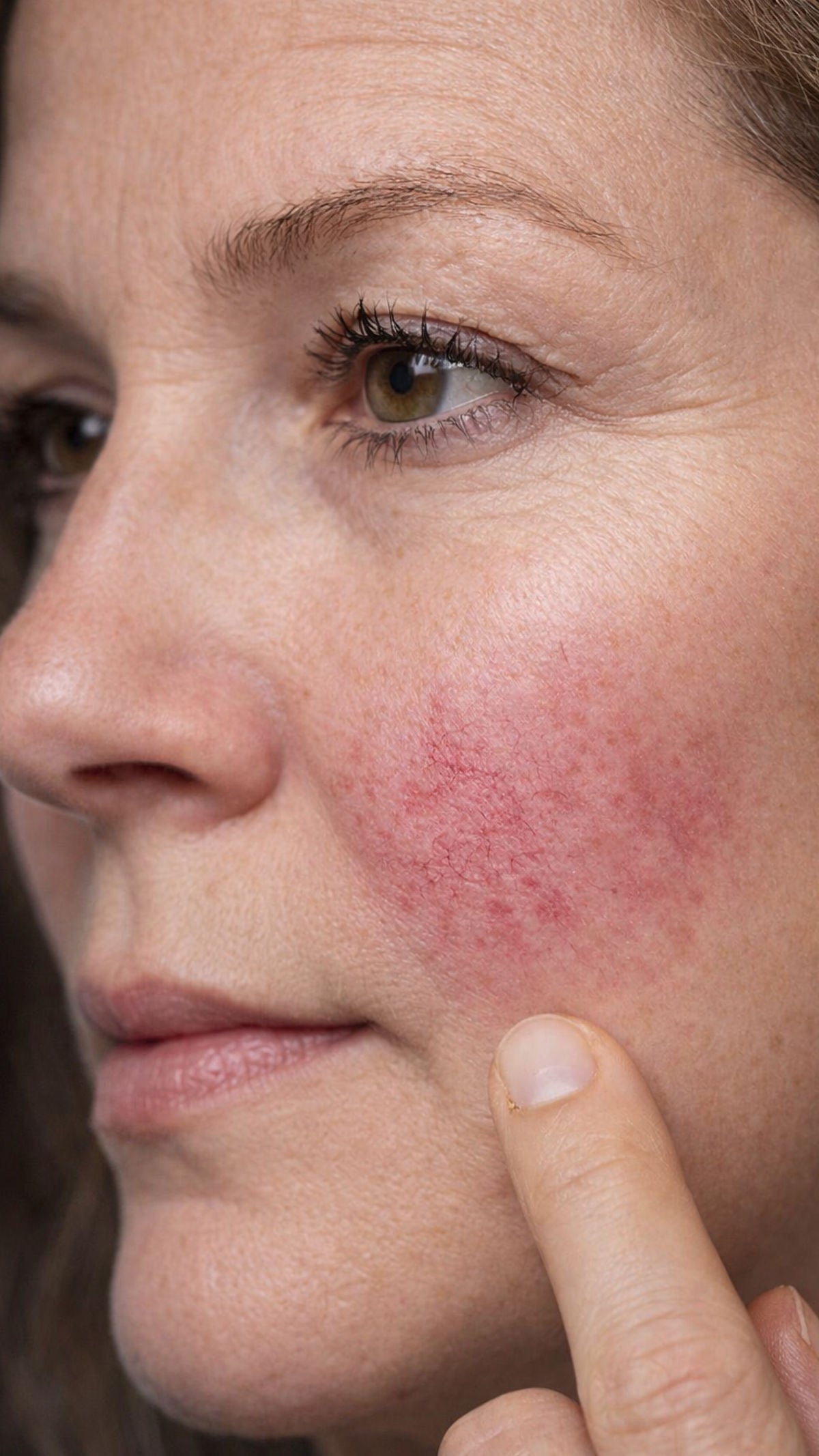 Rosacea