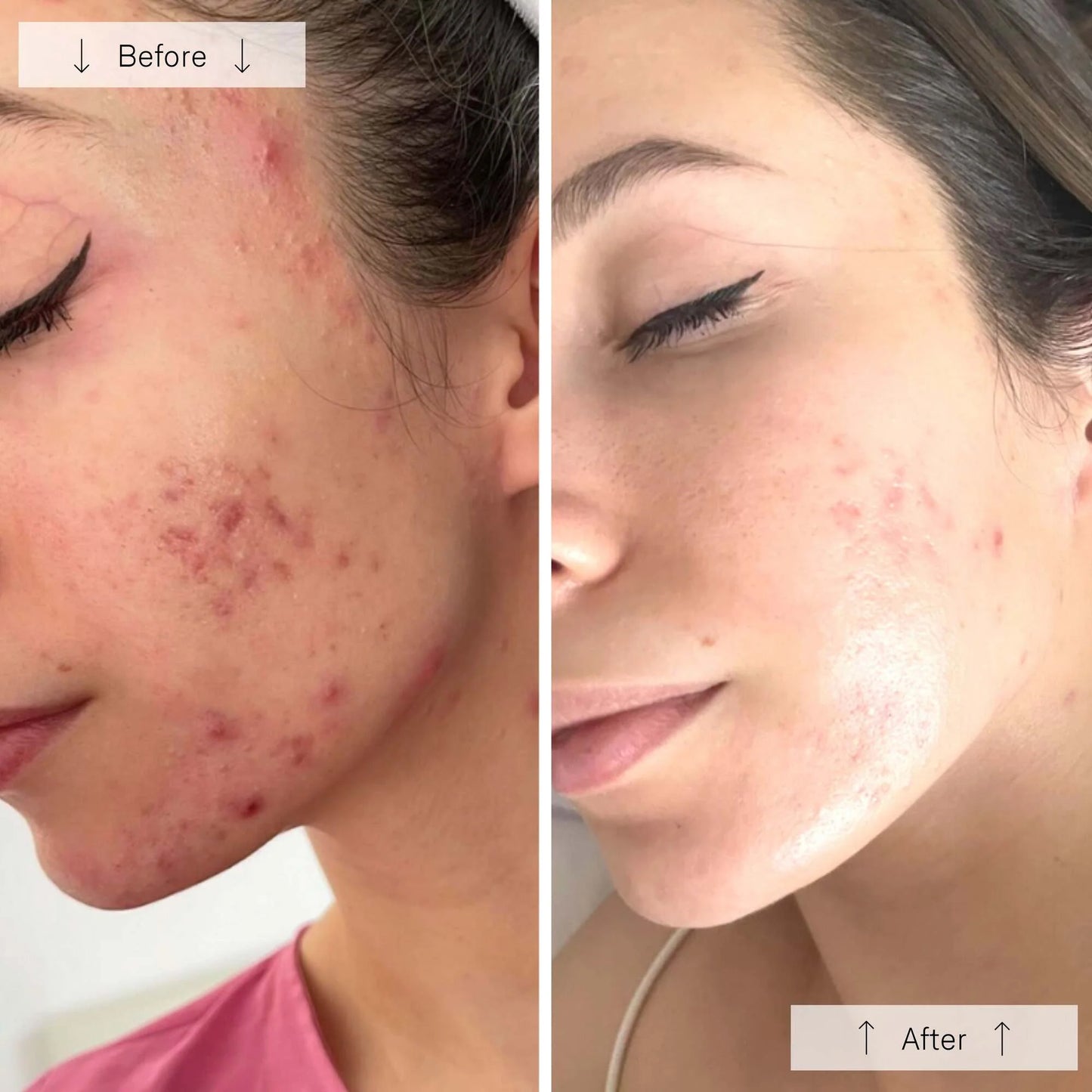 Omnilux Clear │ Blue + Red LED Device for Acne