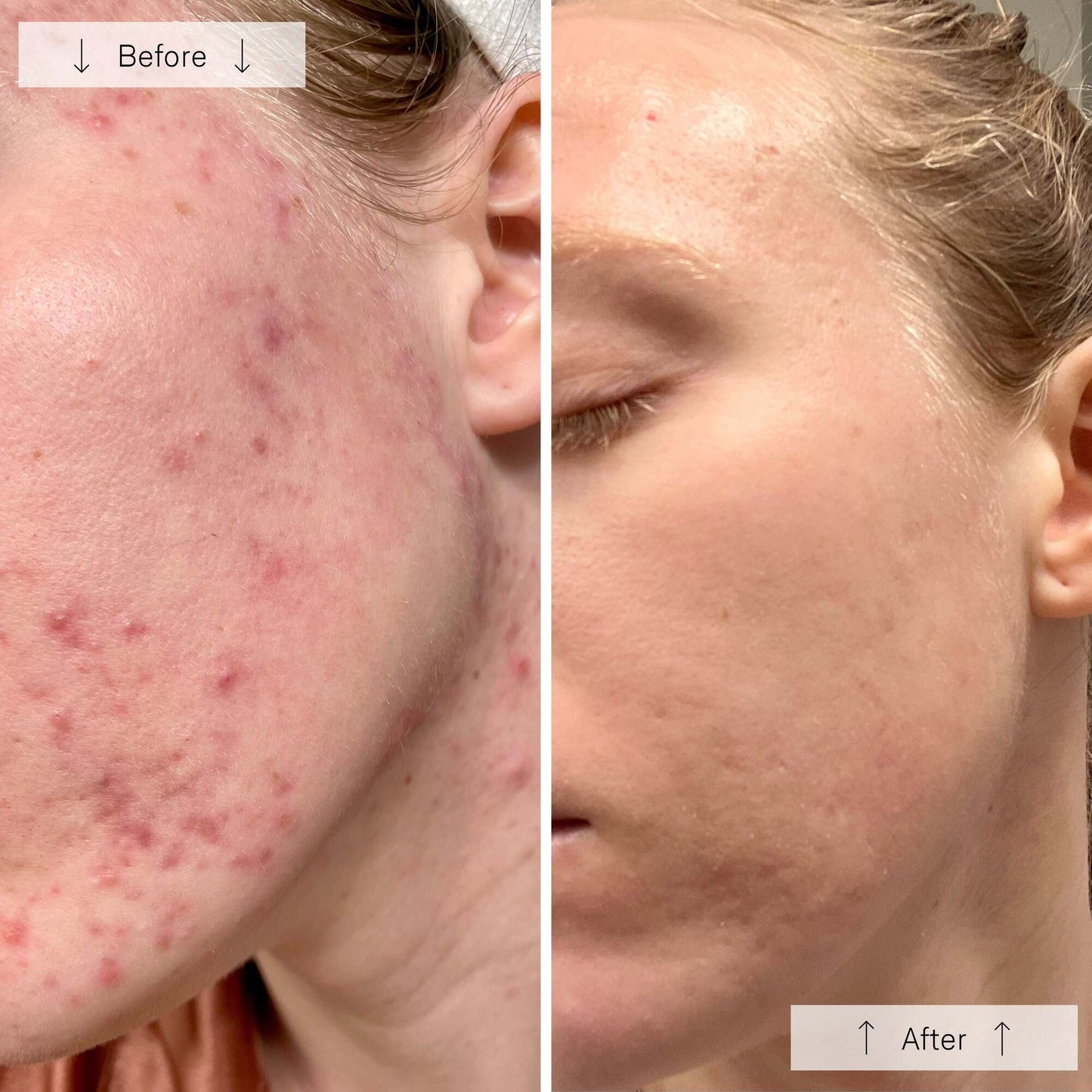 Omnilux Clear │ Blue + Red LED Device for Acne