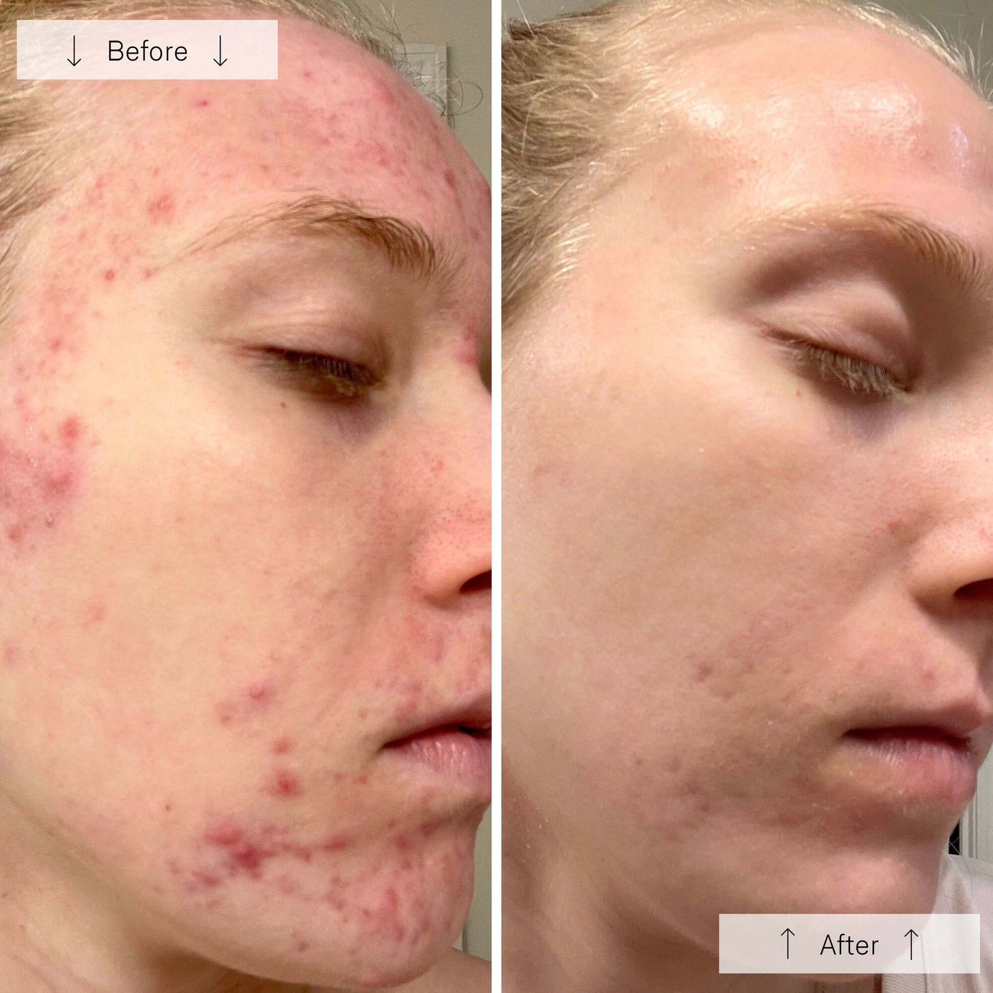 Omnilux Clear │ Blue + Red LED Device for Acne