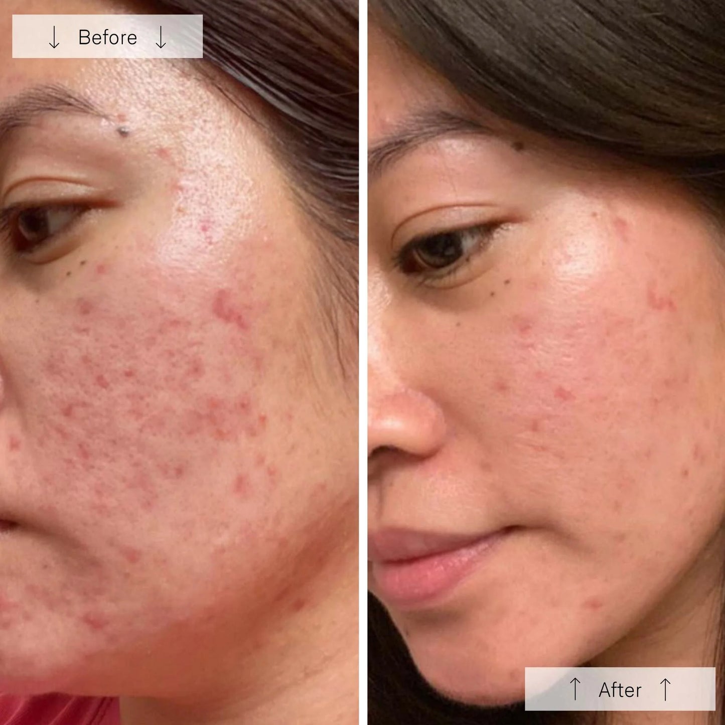 Omnilux Clear │ Blue + Red LED Device for Acne